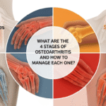What Are the 4 Stages of Osteoarthritis and How to Manage Each One?